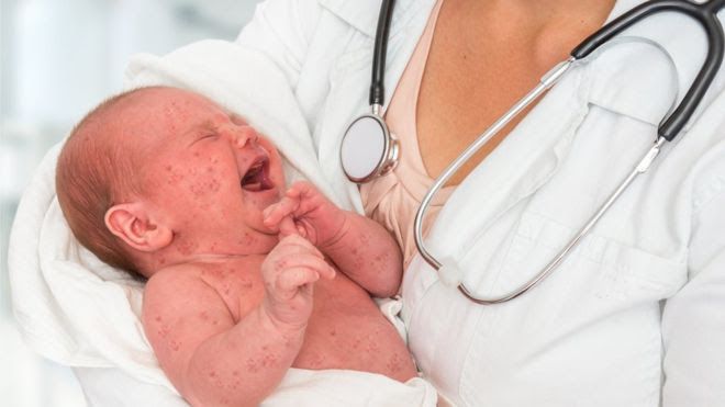 News Photo 1 - U.K. - Otta Nottathil - 20820195measles