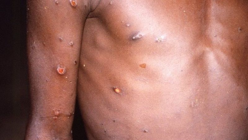 News Photo 1 - Europe - Otta Nottathil - monkey_pox_12_countires
